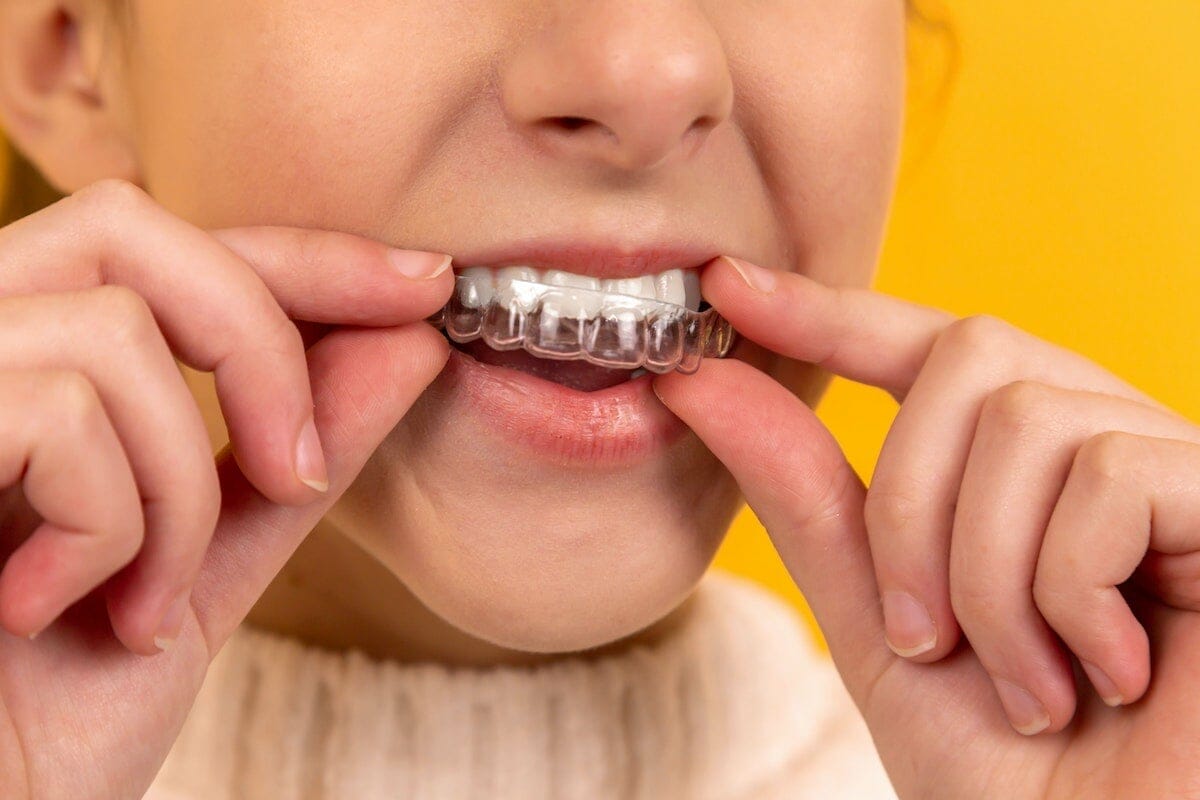 Clear aligners