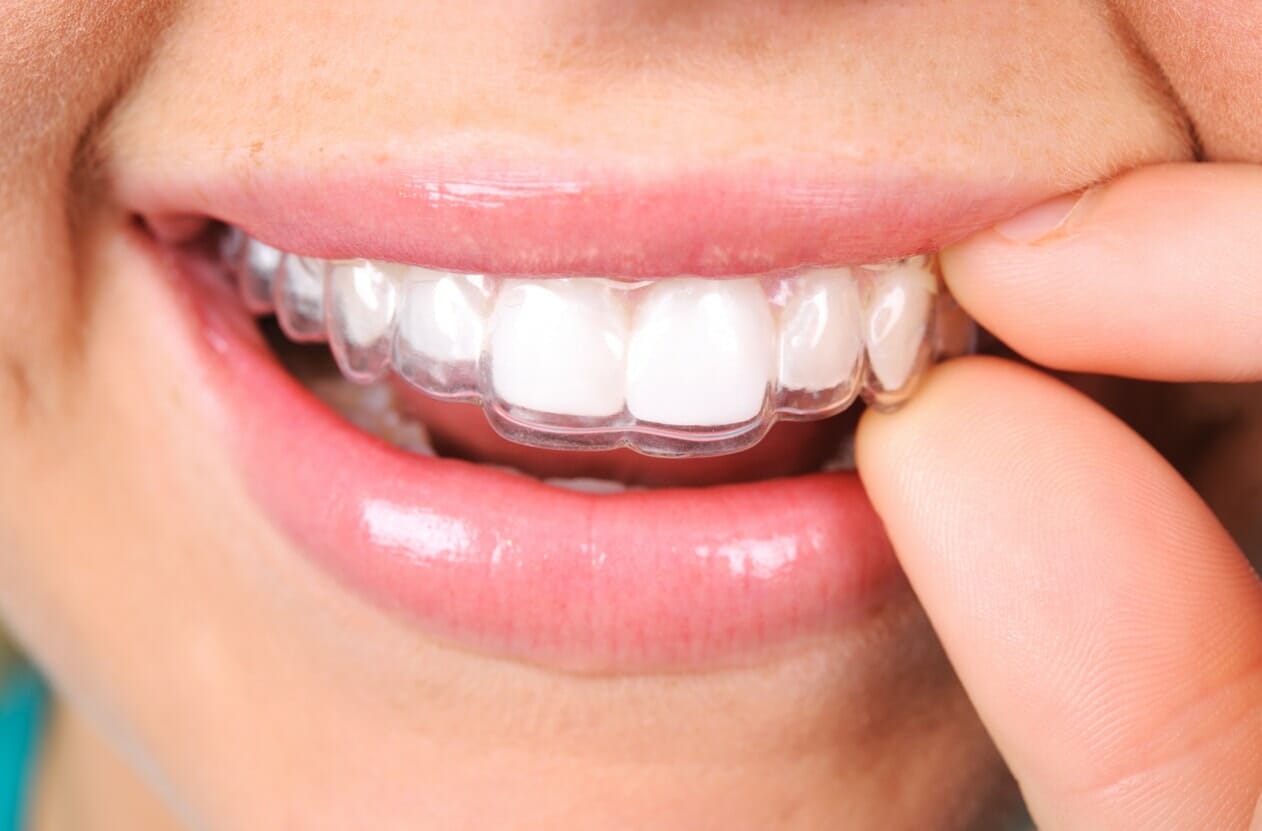 aligner