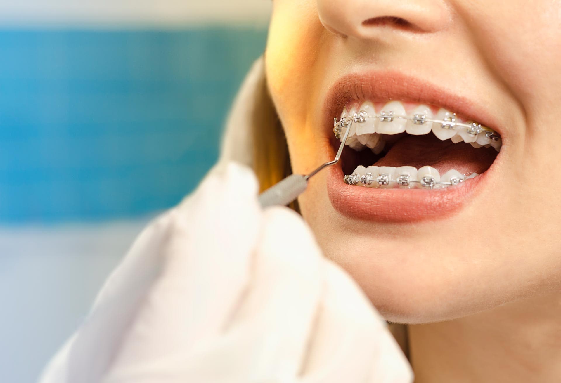 Brace Yourself: A Guide to How Much do Braces Cost in NZ