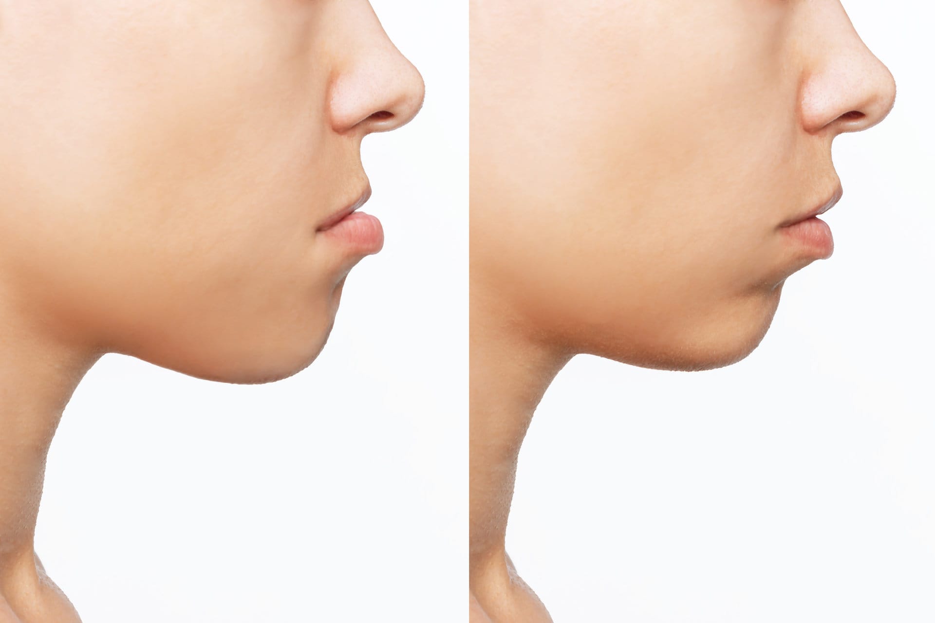 Overbite correction