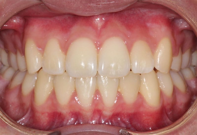 Crowding-after Crowding-after