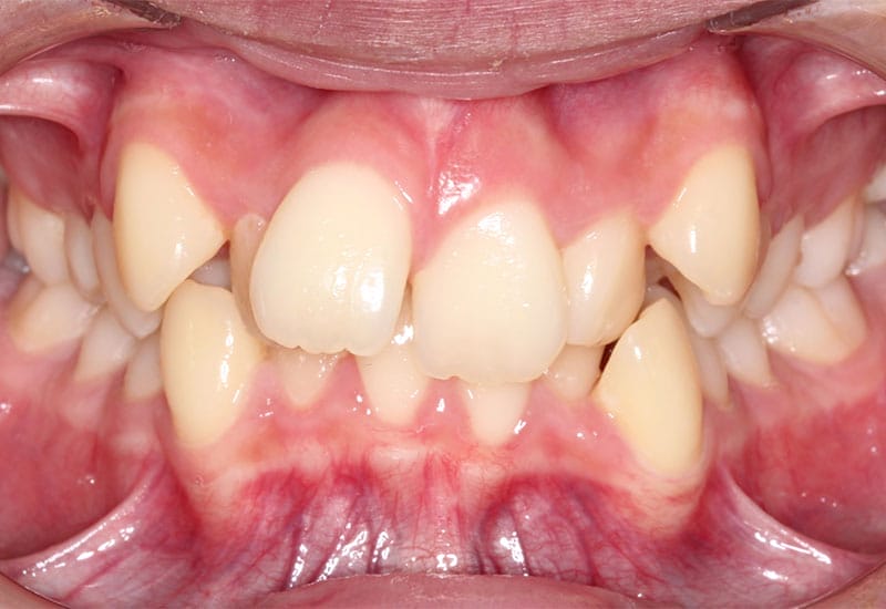 Crowding-before Crowding-before