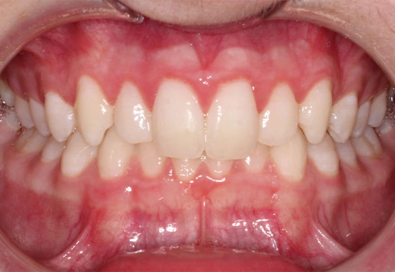 Deep-bite-non-surgical-before Deep-bite-non-surgical-before