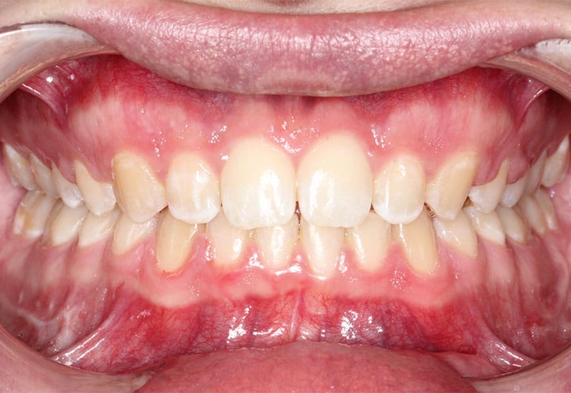 Deep-bite-surgical-after Deep-bite-surgical-after