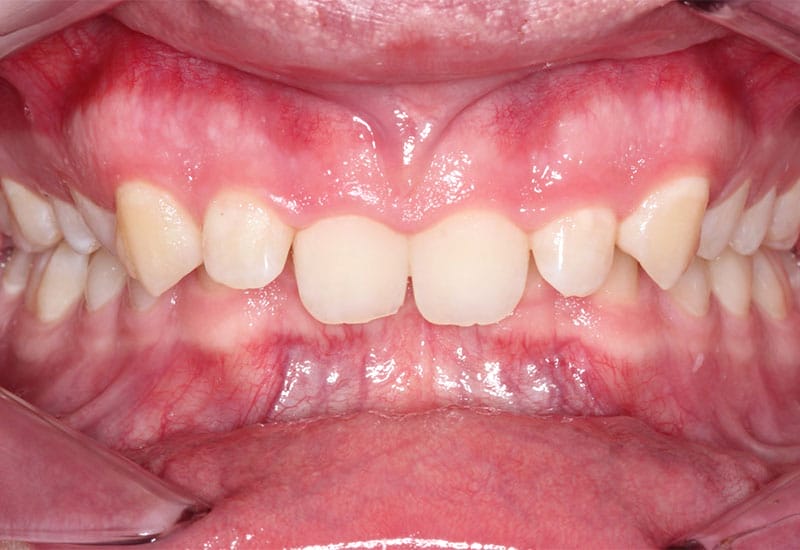 Deep-bite-surgical-before Deep-bite-surgical-before