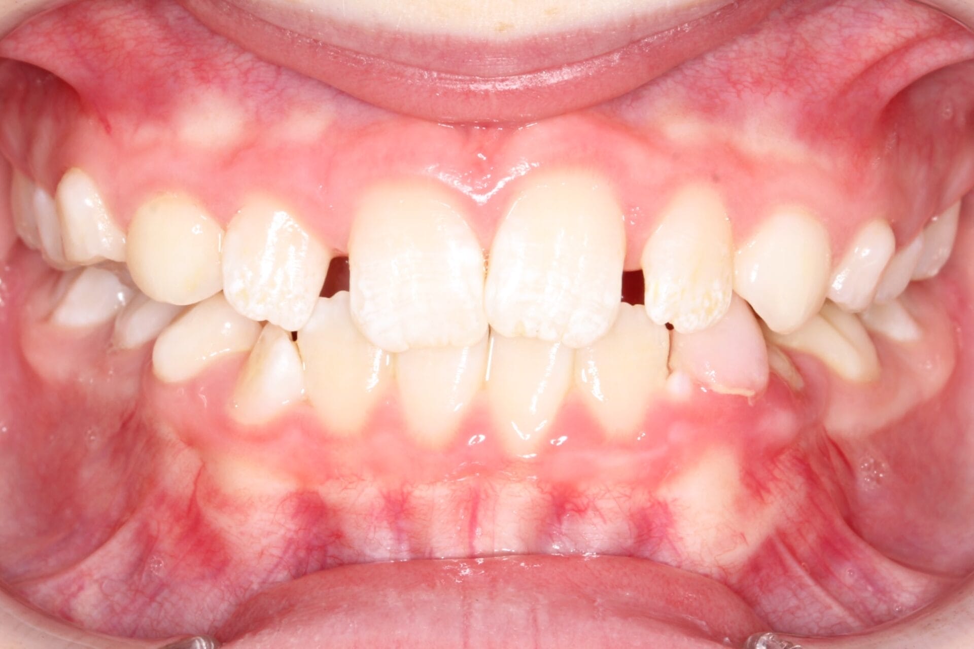 Early Class III after Early Class III after