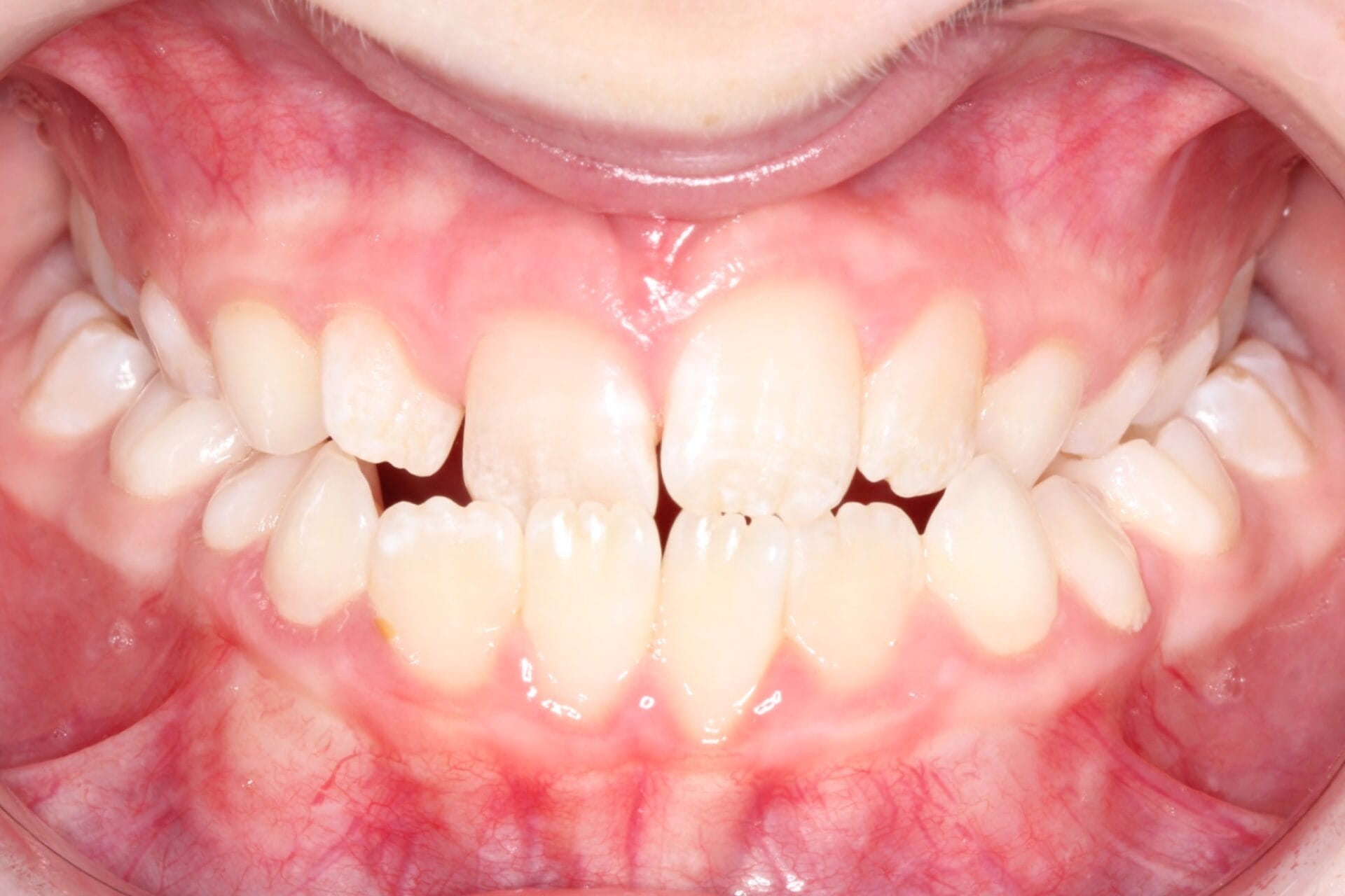 Early Class III before Early Class III before