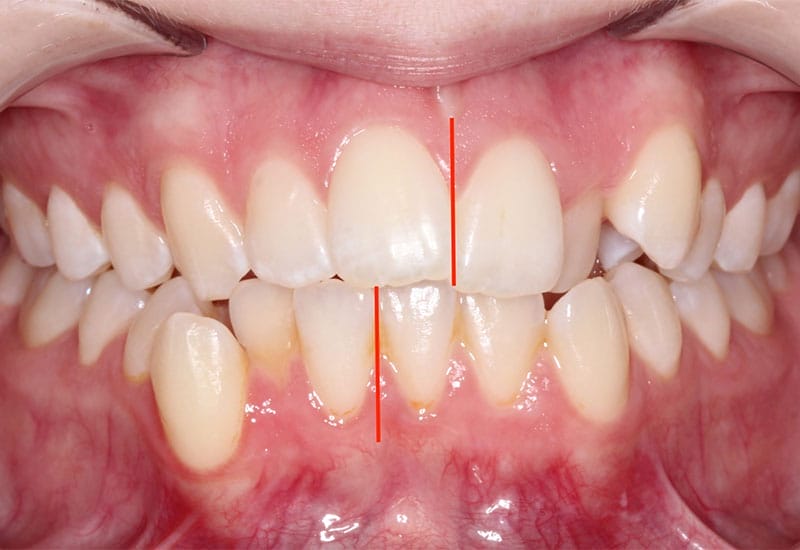 Midline-Deviations-before Midline-Deviations-before